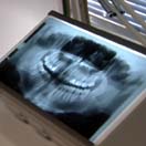 Röntgenkuva hampaista, kuva YLE/videokuvaa